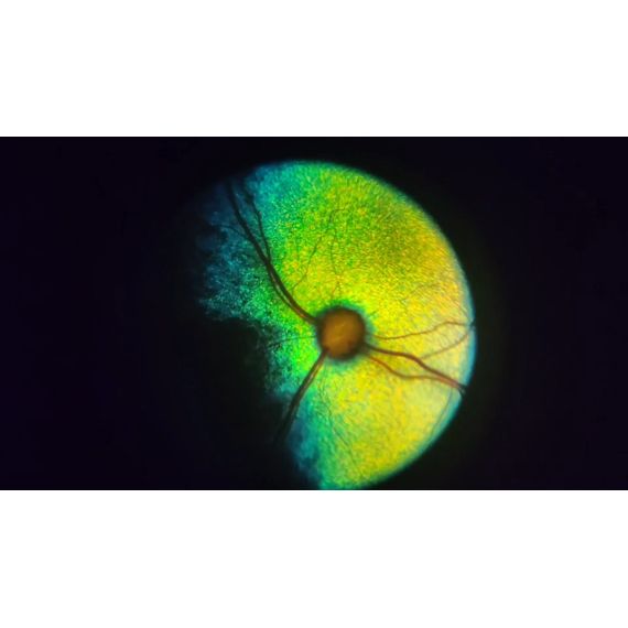 Портативный офтальмоскоп oDocs nun | Пример визуализации